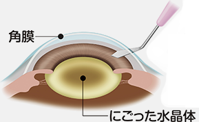 強膜および角膜を最小限切開します