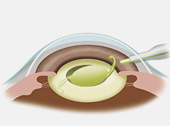 眼内レンズを挿入します