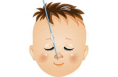 赤ちゃんの先天性鼻涙管閉塞の治療